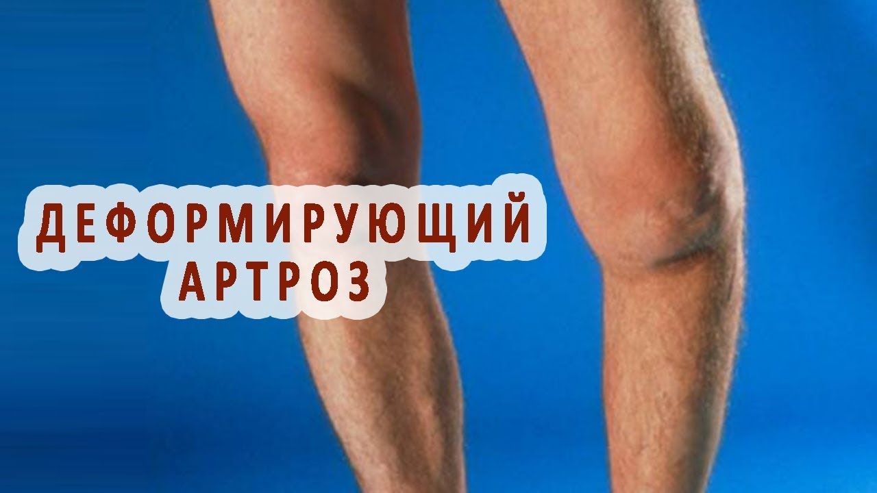 Артроз что это такое видео thumbnail