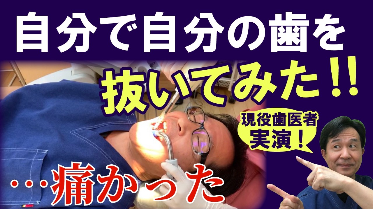 自分で自分の歯を抜いてみた！…痛かった🥲