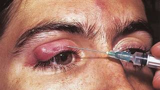 Stye & Hordeolum Abscess Drainage Tutorial