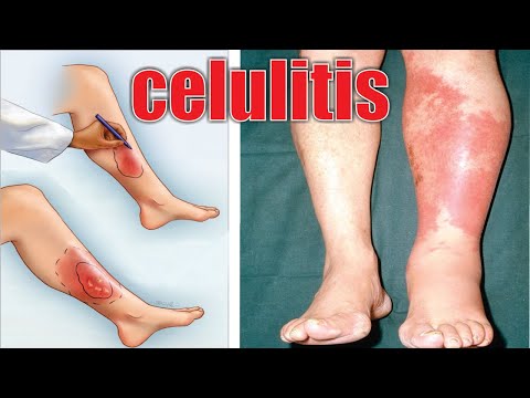 Video: ¿La celulitis es algo malo?