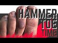 Hammer Toe Surgery
