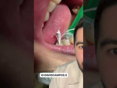Video: 3 maneras comunes de desgastar los dientes y garras de gerbil