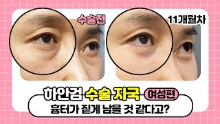 1분동안 몰아서보는 하안검 후 11개월의 회복 과정