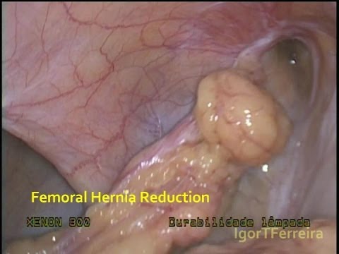 Hernia Femoral TAPP / Suture Mesh Fixation + V-Lock