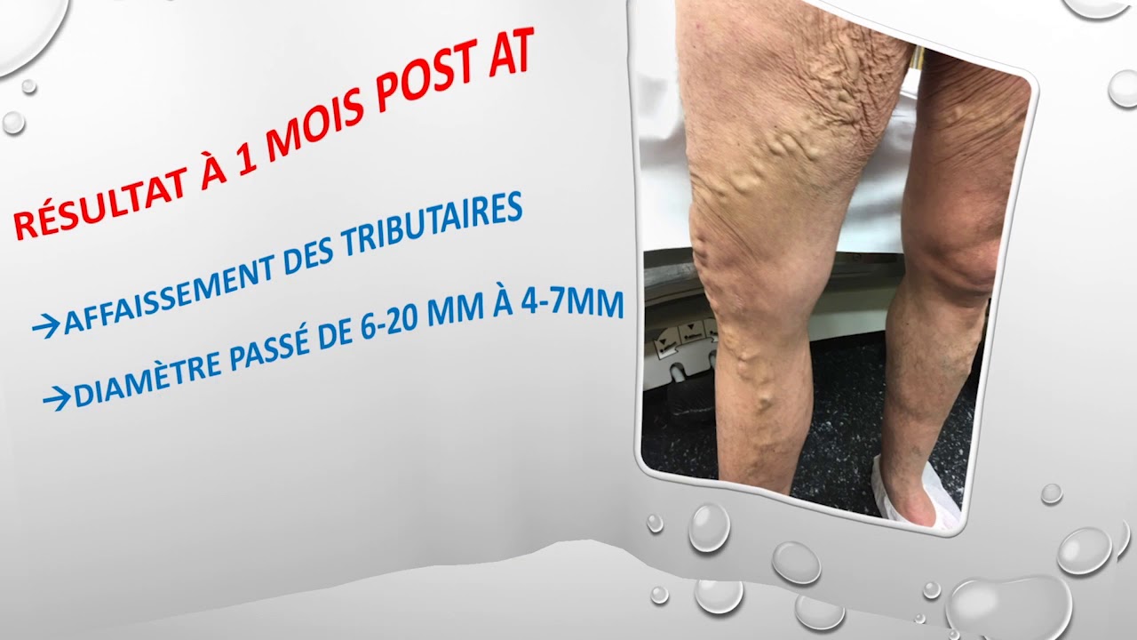 Traitement en 2 temps des varices volumineuses YouTube Traitement en 2 temps des varices volumineuses YouTube
