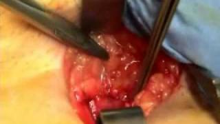 Operation varices youtube des