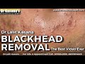 Blackhead removal by drlalit kasana  best blackhead removal