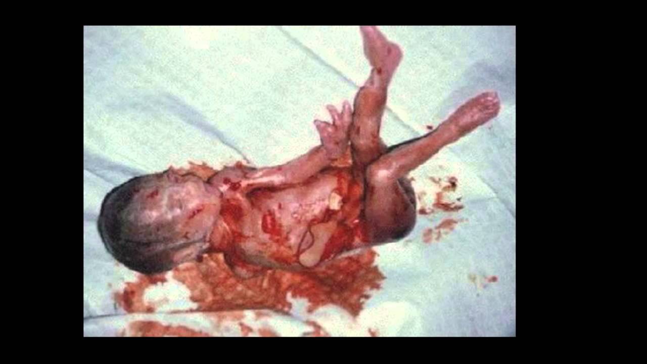 Embarazo Después De Un Aborto Foro EL ABORTO - YouTube