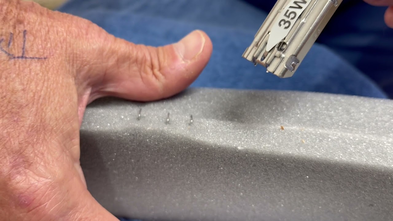 Staple Removal Post Bariatric Surgery Dr  Walter Medlin