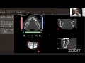 Software Tomografía NNT para Implantología