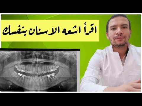 فيديو: لماذا يتم أخذ الصور الشعاعية حول الذروة؟