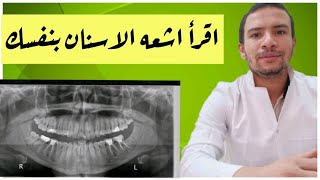 كيف تقرأ اشعه الاسنان بنفسك /خراج الاسنان و مشاكل حشو العصب من خلال الاشعه