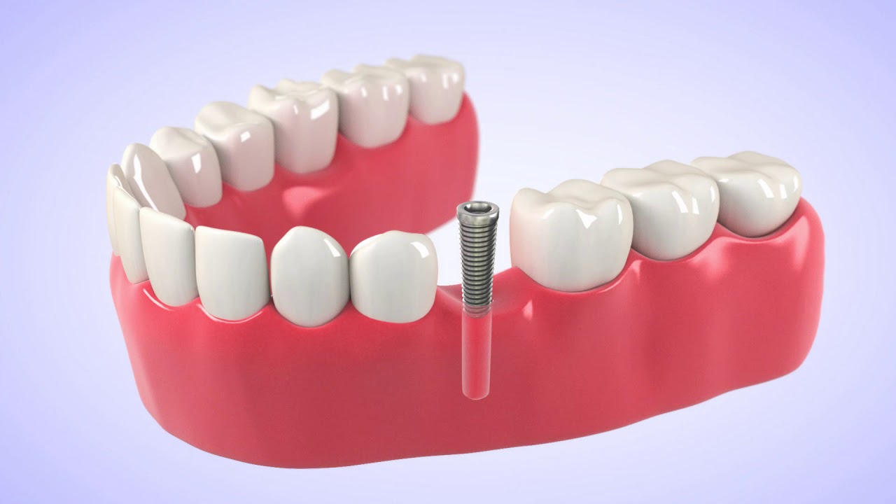 Dental Implants Bonita Springs, FL Dr. Frederick Eck YouTube