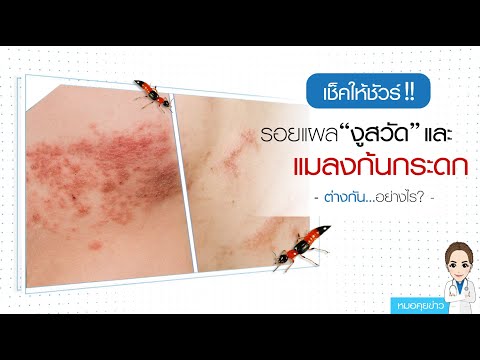 "ตรวจสอบเพื่อให้แน่ใจ  งูสวัด VS งูสวัด ต่างกันอย่างไร?" : Doctor Talking News : รายการคุยกับหมออัจจิมา