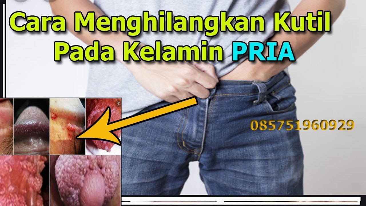 Cara Menghilangkan Penyakit Kulit Pada Kelamin Pria ( KUTIL ) - YouTube