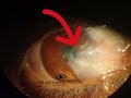 Pterygium The Eye Disease That S Gotten Weirdly Popular 