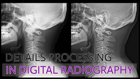 Details Processing in Digital Radiography