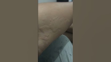 Thumbnail of obat biduran asli langsung sembuh 1jam