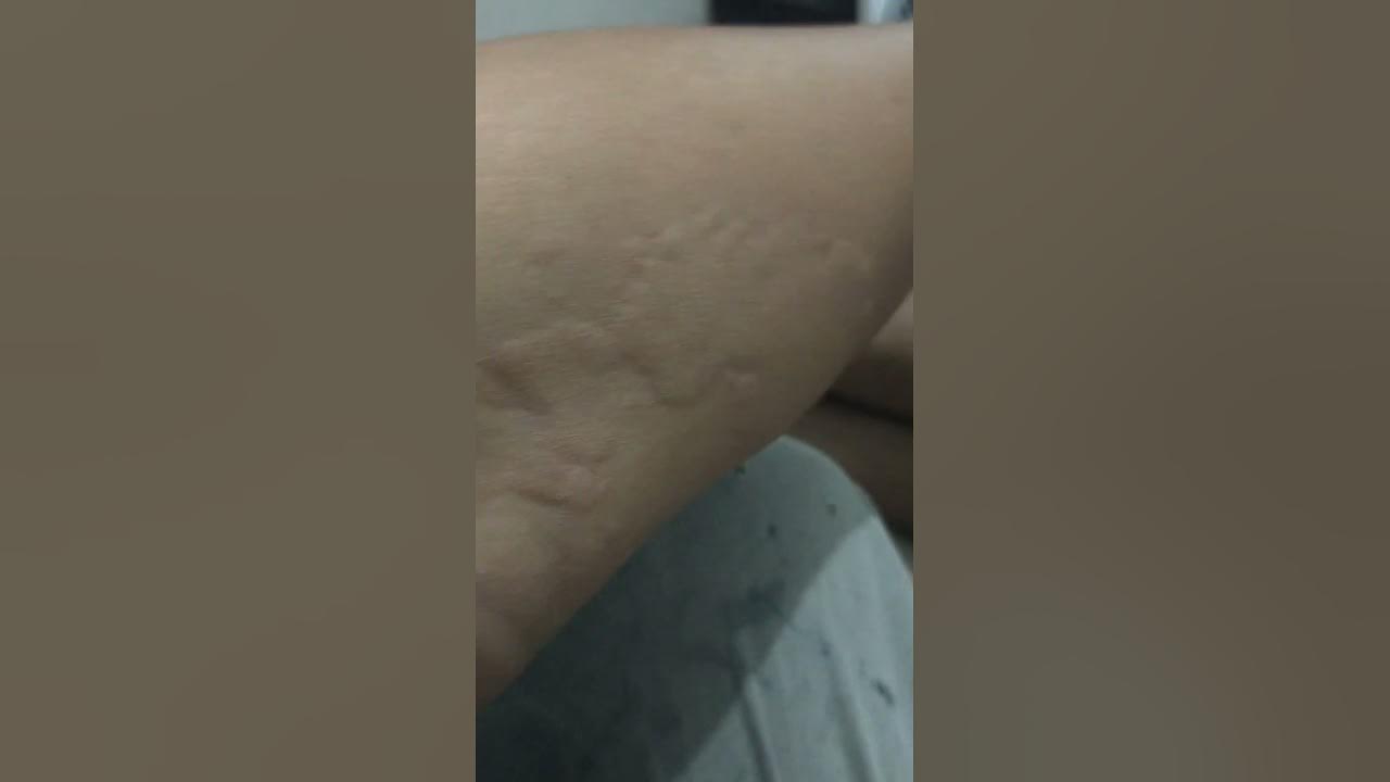 obat biduran asli langsung sembuh 1jam