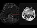 TMT: MRI of ACL tears by Dr Srijita Ghosh