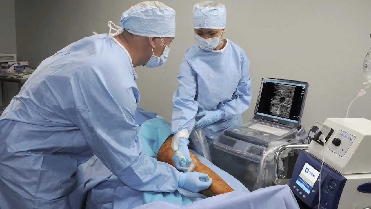 Endovenosa láser ablación (vela) con