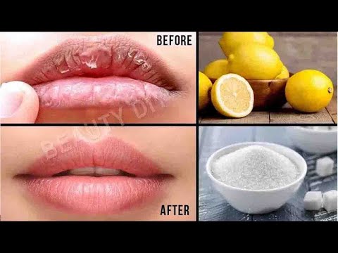 Video: Home Remedies For Chapped Lips: 5 Natuurlijke Doe-het-zelfbehandelingen