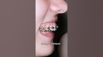 Braces fix gummy smile and overbite teeth #braces #orthodontist #dentist
