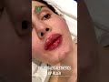 Lip filler at the krisalys