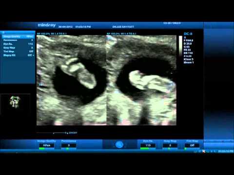 Ultrasound Of Pregnancy At 24 Weeks Youtube
