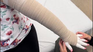 Arm bandaging for left arm lymphedema Part 2. See part 1 for the fingers.