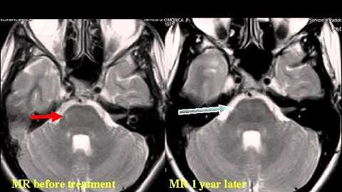 "ENDOVASCULAR TREATMENT of CEREBRAL VENOUS INSUFFICIENCY associated to MULTIPLE SCLEROSIS"