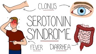 Serotonin Syndrome Explained (Serotonin Toxicity)