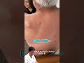 【粉瘤直撃】粉瘤の垢が顔面にかかってしまう!たかし先生も強引な処置に苦笑い!