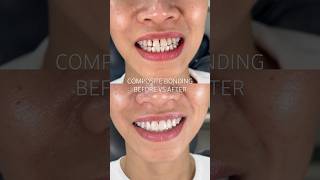 Composite bonding before vs after by Dr. Sonnie 😍🙌 #compositebonding #newsmile