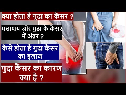 What is Anal cancer? एनल कैंसर क्या होता है ?जानिए हिंदी में