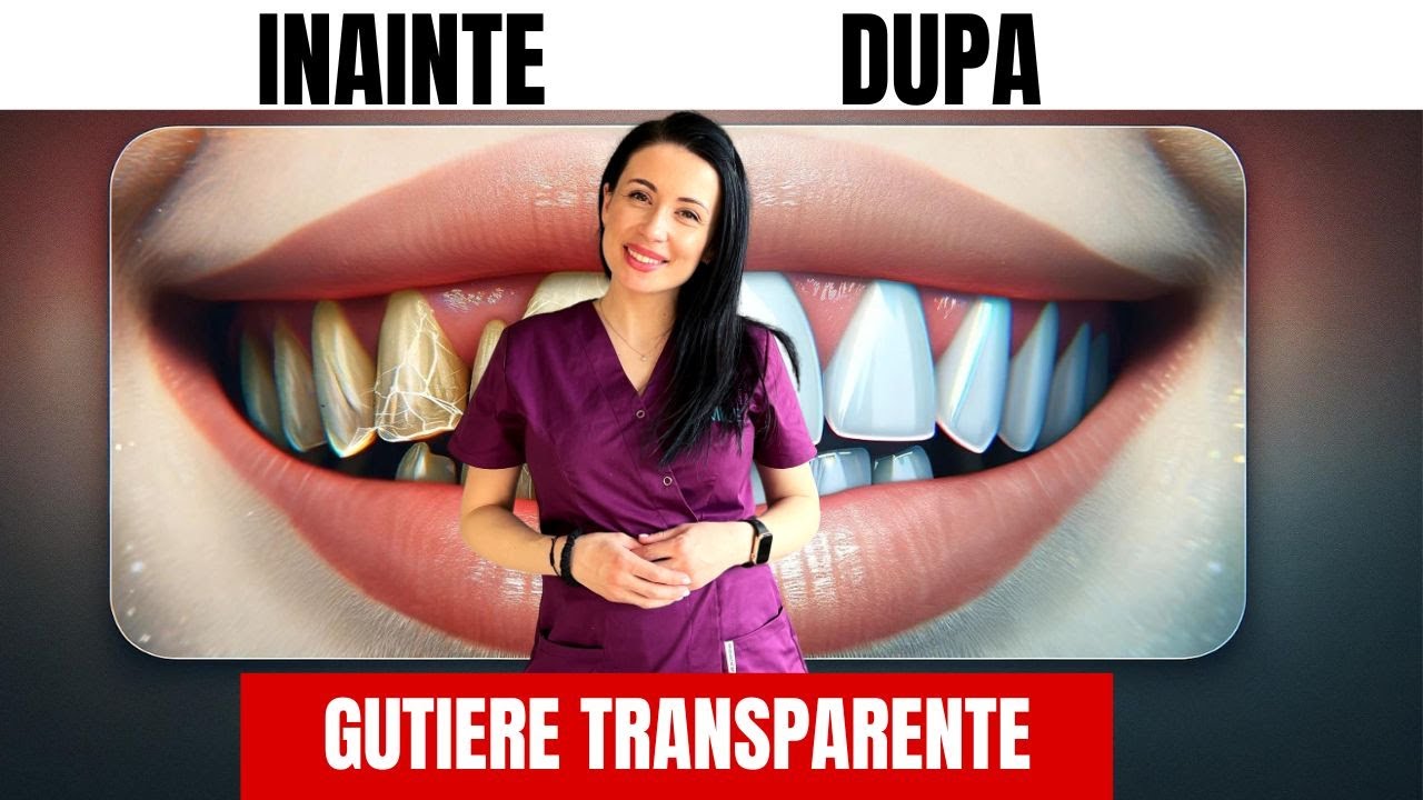 Ghid Complet despre Gutiere Dentare: Alegerea Medicului, Beneficii și Îngrijire