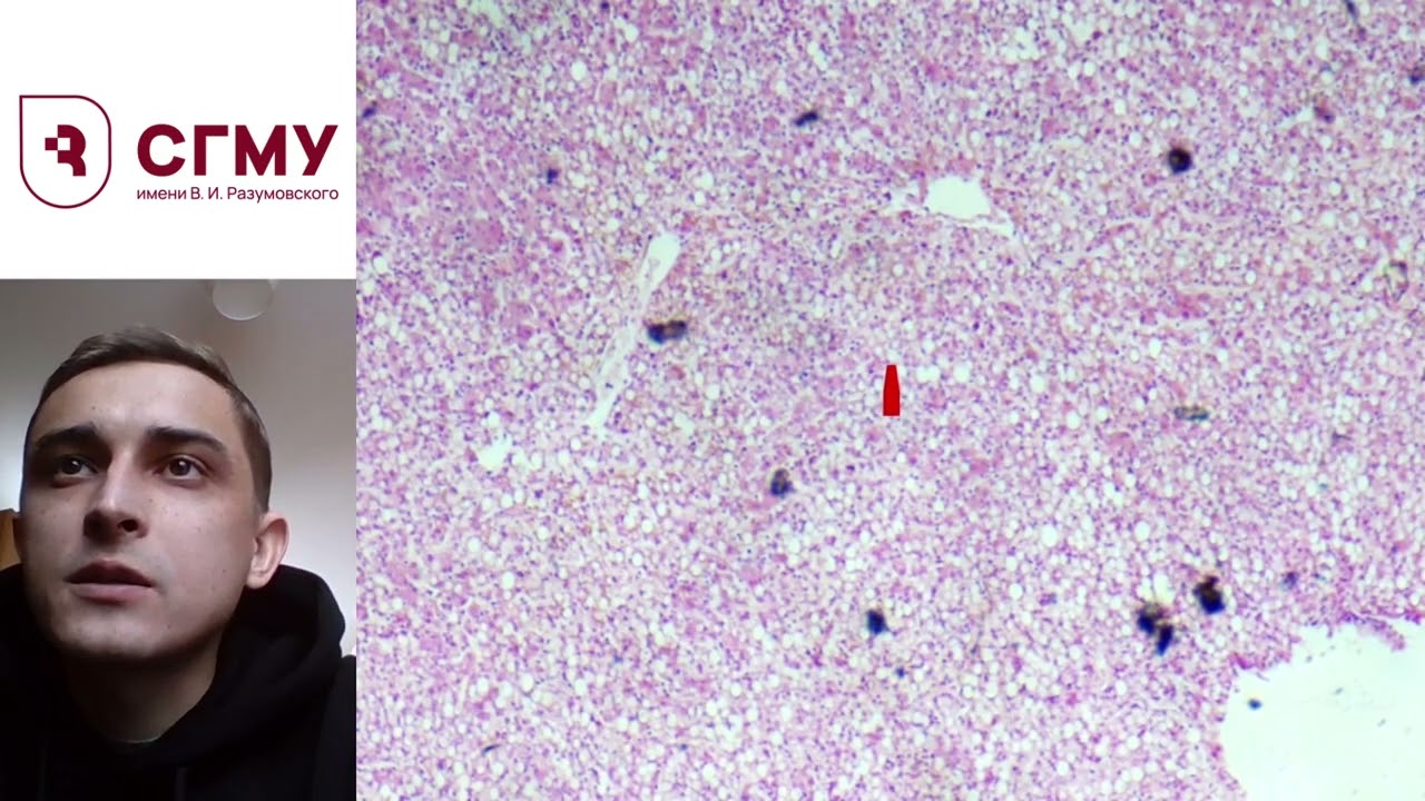 Жировая дистрофия печени