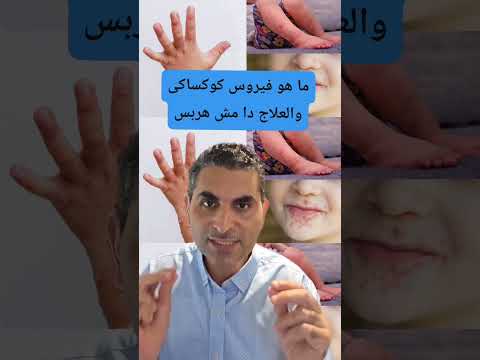 ما هو فيروس كوكساكى والعلاج دا مش هربس منتشر ومهم روشتة وصلها للجميع دكتوروليدشوقى
