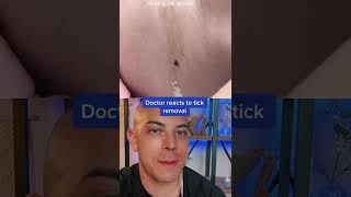 Crazy Tick Removal Doctor Reacts