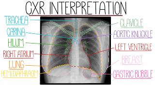 Learn to Interpret a Chest X Ray in 12 Minutes (With Pathology Examples)