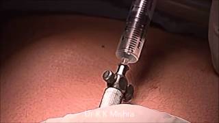 Laparoscopic Access Technique Using Veress Needle