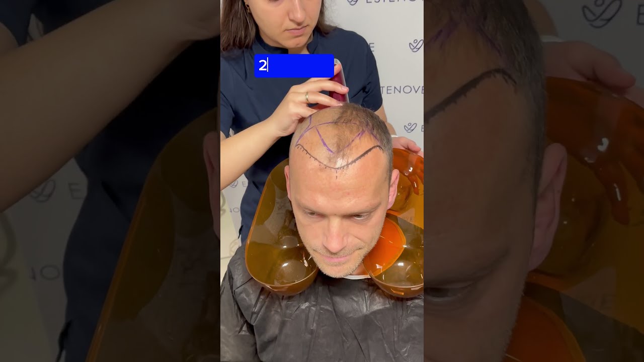 You Re Ready For The Operation Hairtransplant Trendingshorts