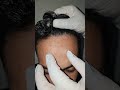 الفصد لعلاج الشقيقه والصداع النصفي وثقل الرأس الفصد علاج نهائي للشقيقه