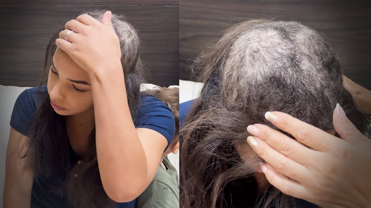 Presenteei com uma prótese a inscrita que sofre com tricotilomania!