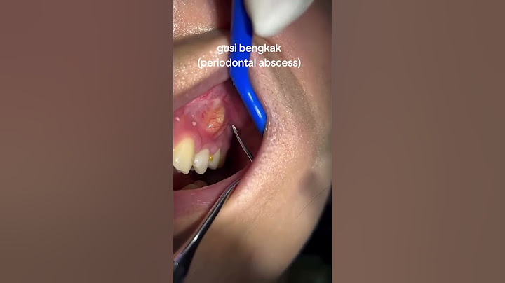 🦷GUSI BERNANAH, SIAPA YANG PERNAH MENGALAMI?
