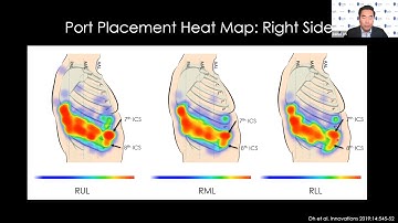 Robotic-Assisted Lobectomy Port Strategy