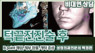 턱끝전진술 후 체부 함몰, B포인트 꺼짐, 개턱 증상 [비대면상담 #173] / Chin depression after chin augmentation surgery