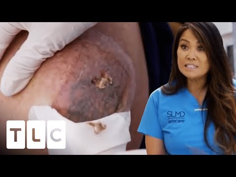 Spoon Is Used To Remove Man's Cyst! | Dr. Pimple Popper