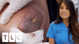 Spoon Is Used To Remove Man's Cyst! | Dr. Pimple Popper screenshot 2