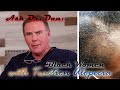 Traction Alopecia for Black Women - Ask Dr. Dan about Hair Transplant Results
